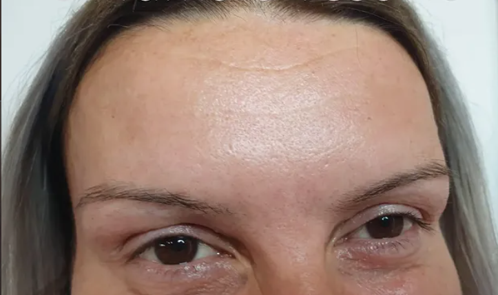 Posle botox tretmana